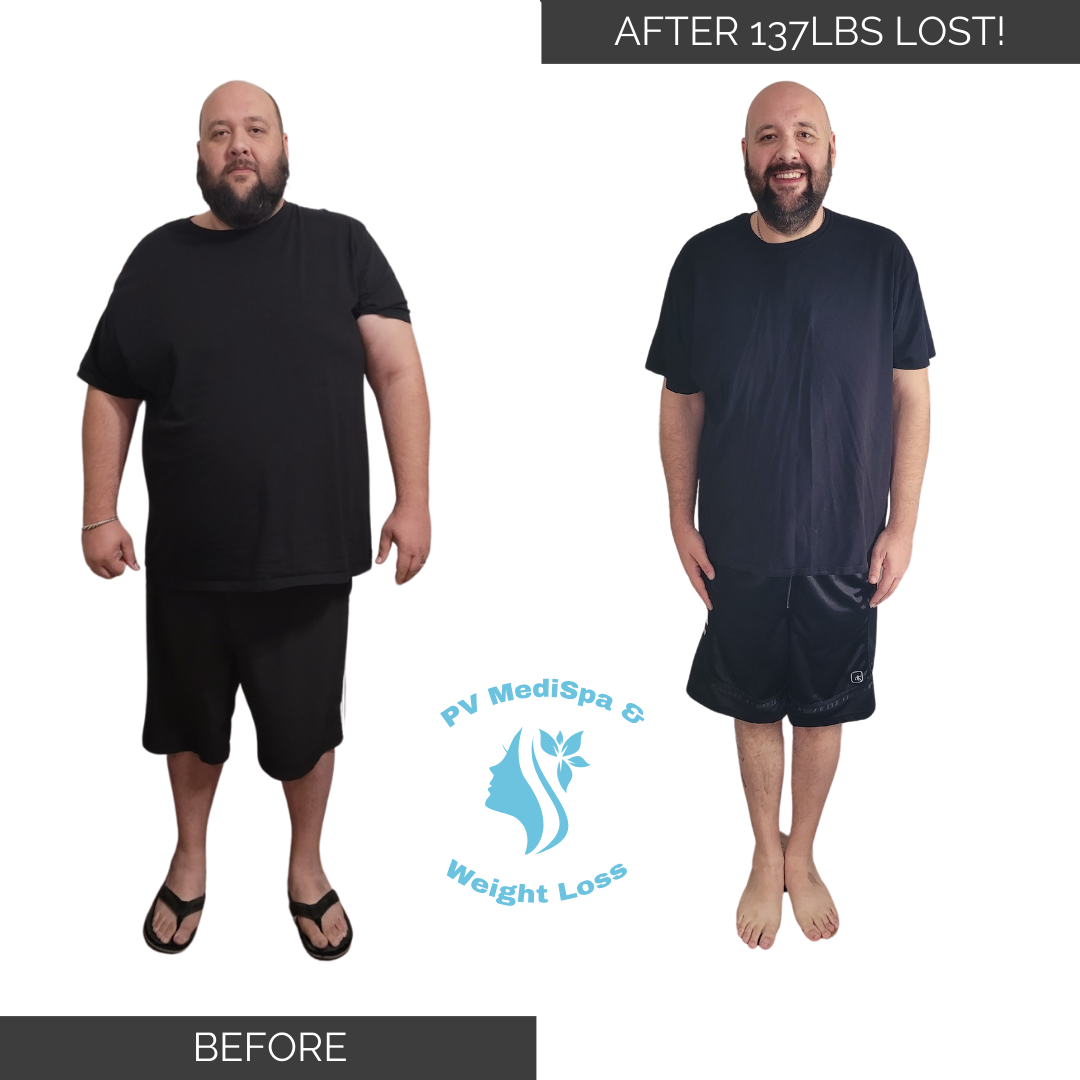 Weight loss transformation - 137 pounds lost
