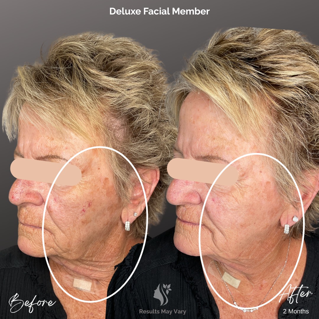 Deluxe facial results after 2 months