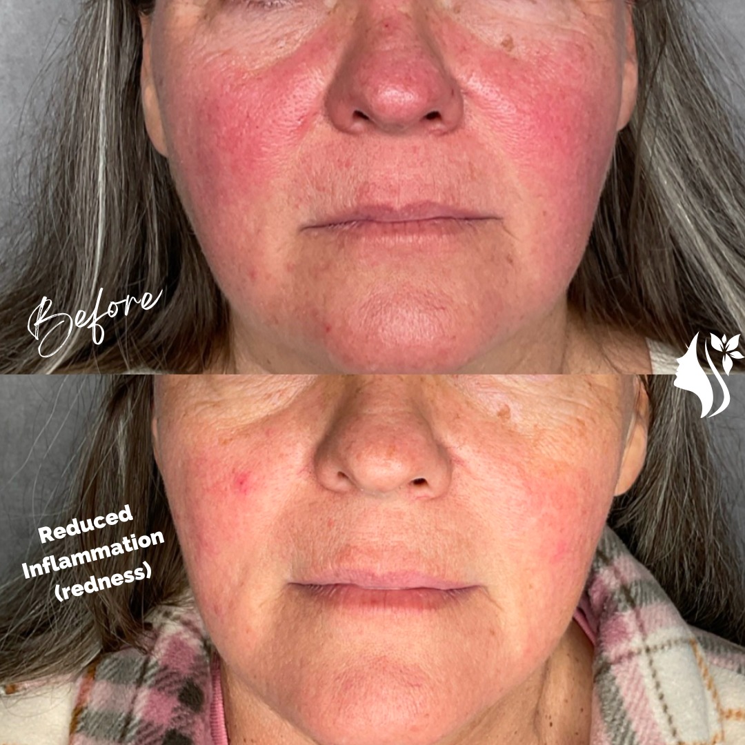 Facial treatment results - reduced inflammation and redness