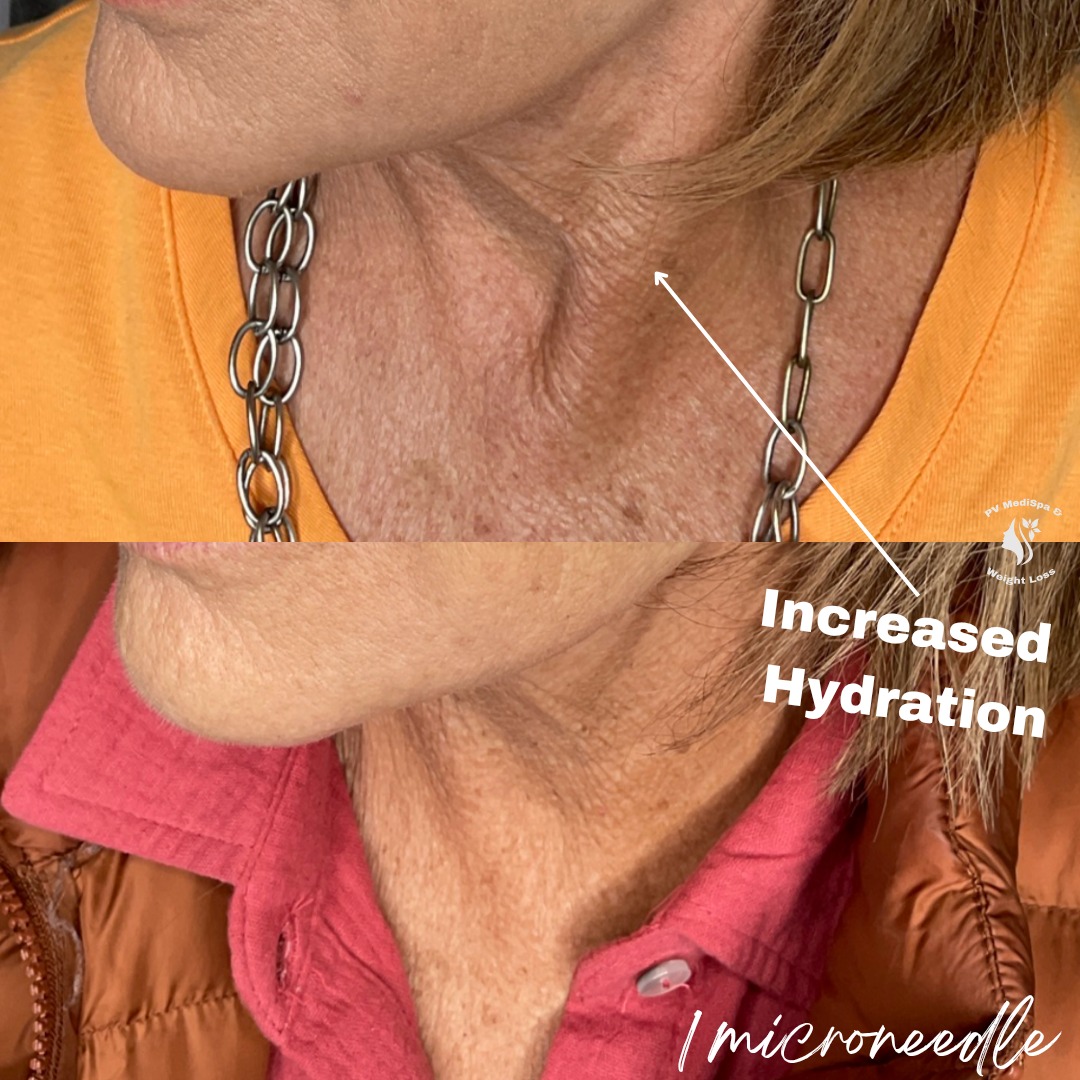 Microneedling results - increased skin hydration