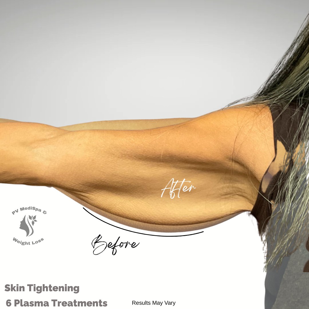 Skin tightening results after 6 plasma treatments